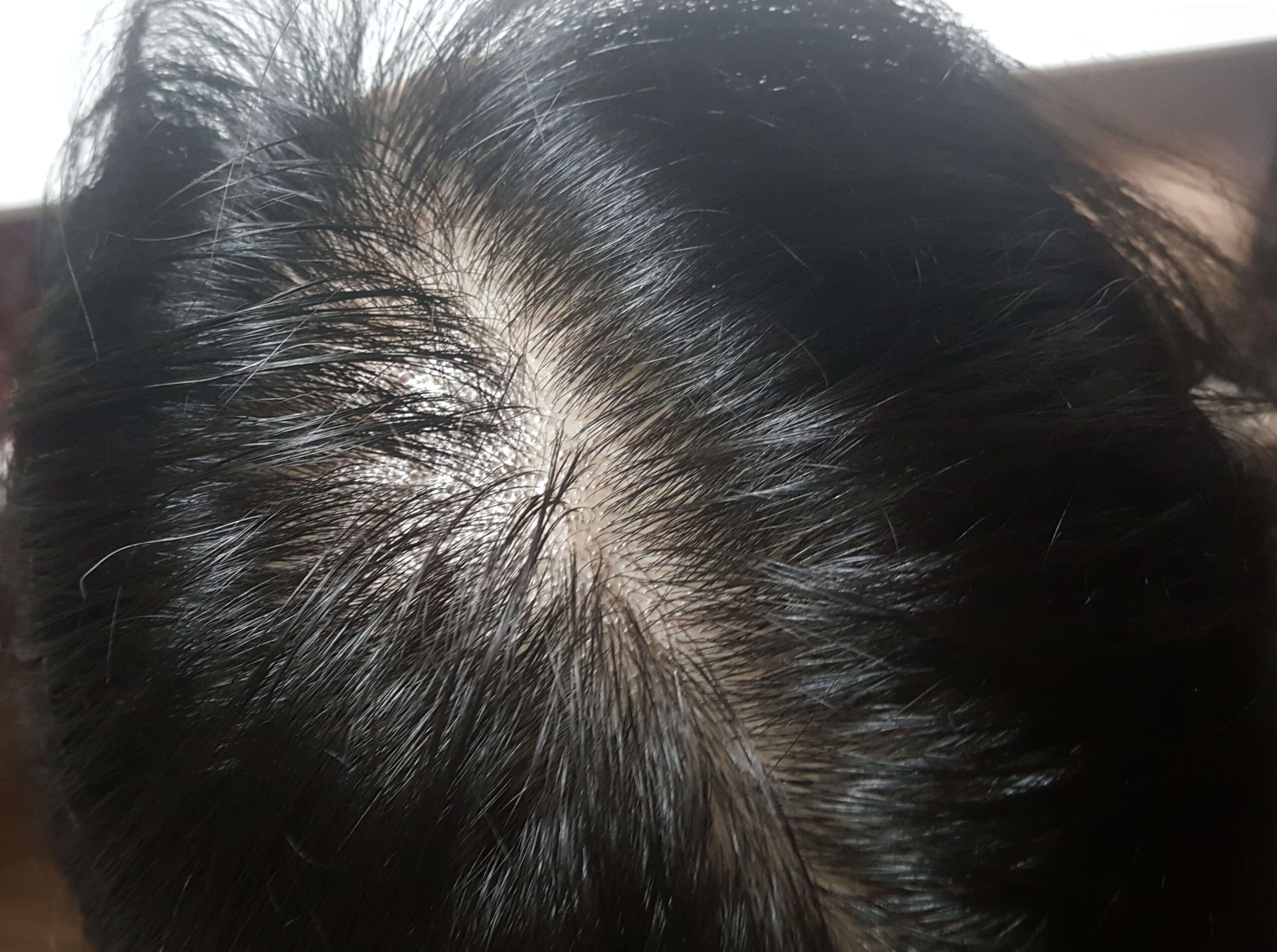 지성두피 관리, 탈모 예방